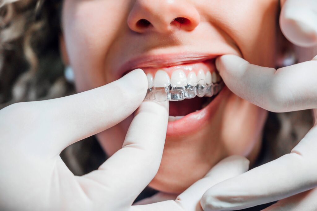 Dentist placing clear aligner on patient